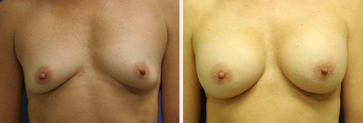 breast augmentation before and after Huntington NY
