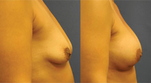 Breast Augmentation - Patient 2