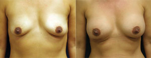  Breast Augmentation Phjoto - Patient 1