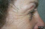 Before & After Blepharoplasty in Huntington NY