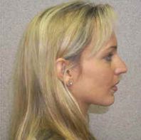 Rhinoplasty Before & After in Huntington, New York