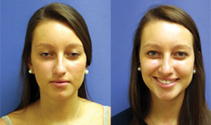 Before & After Photo: Rhinoplasty - Patient 3 (front)