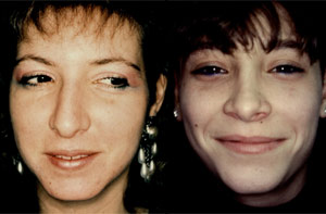 Before & After Photo: Rhinoplasty - Patient 5 (front)