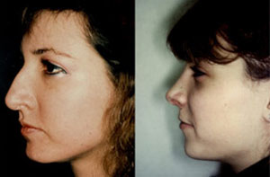 Before & After Photo: Rhinoplasty - Patient 5 (side)