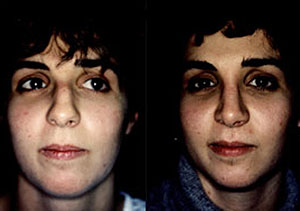 Before & After Photo: Rhinoplasty - Patient 6 (front)