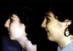 Before & After Photo: Rhinoplasty - Patient 6 (side)