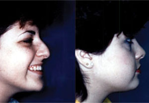 Before & After Photo: Rhinoplasty - Patient 7 (side)