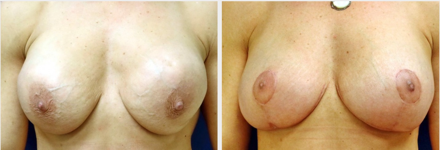 Breast Lift | Associated Plastic Surgeons | Huntington, LI