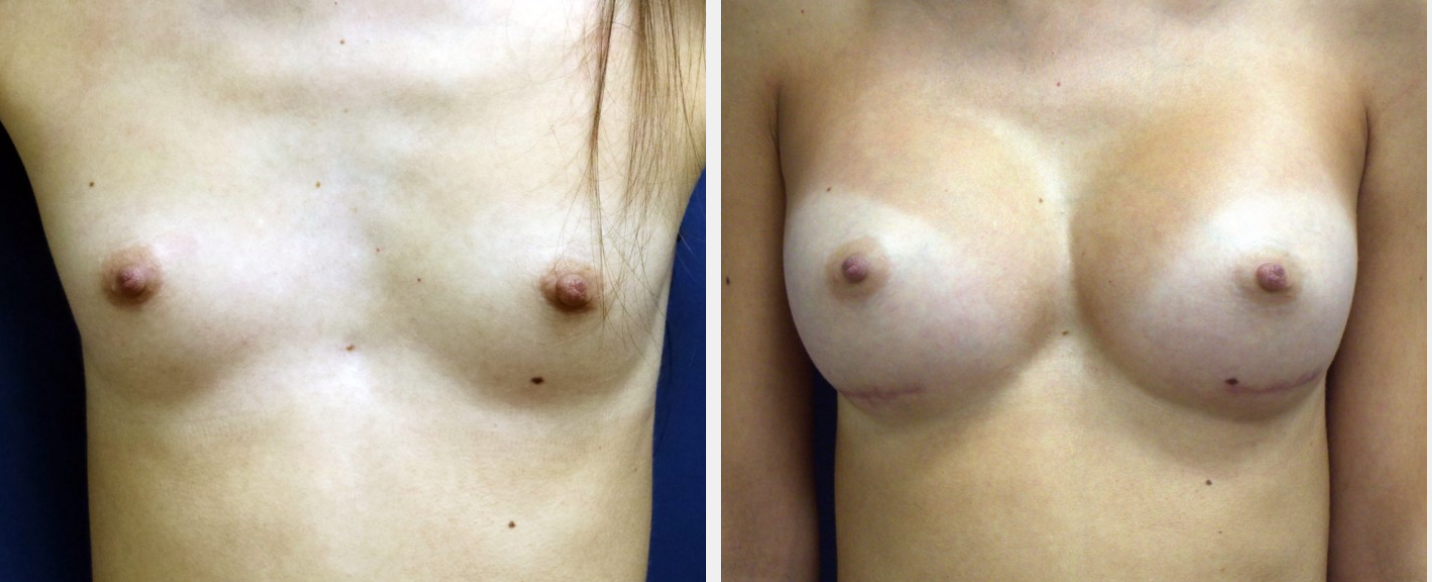 breast augmentation before and after Huntington NY
